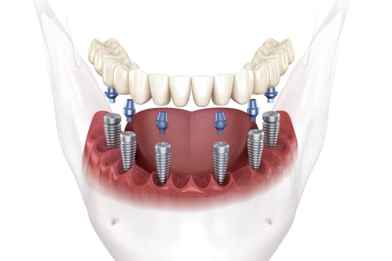 all-on-6-antalya-turkey-dental-implant-01