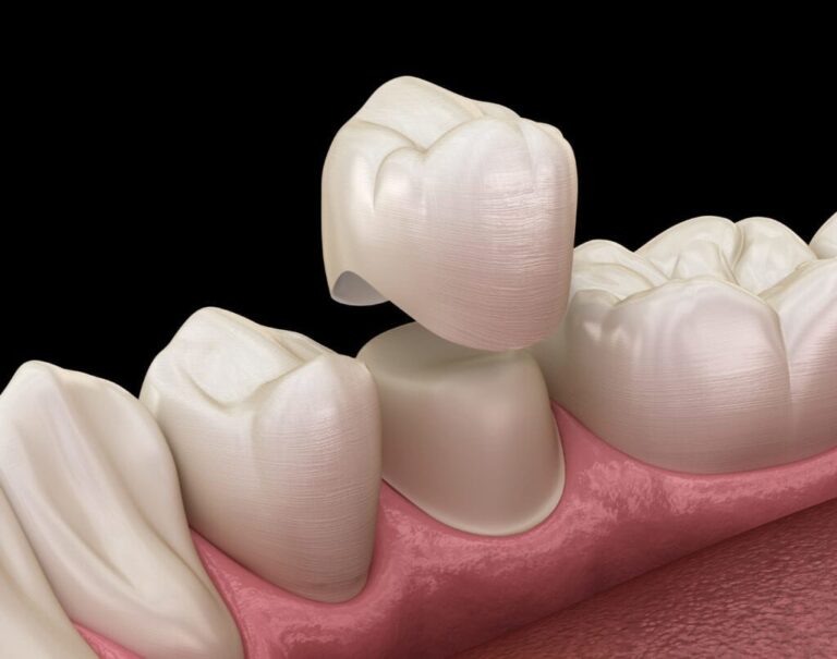 Dental-crown-3d-32-pearls-seattle-dentist-1024x807-1024x807 (1)