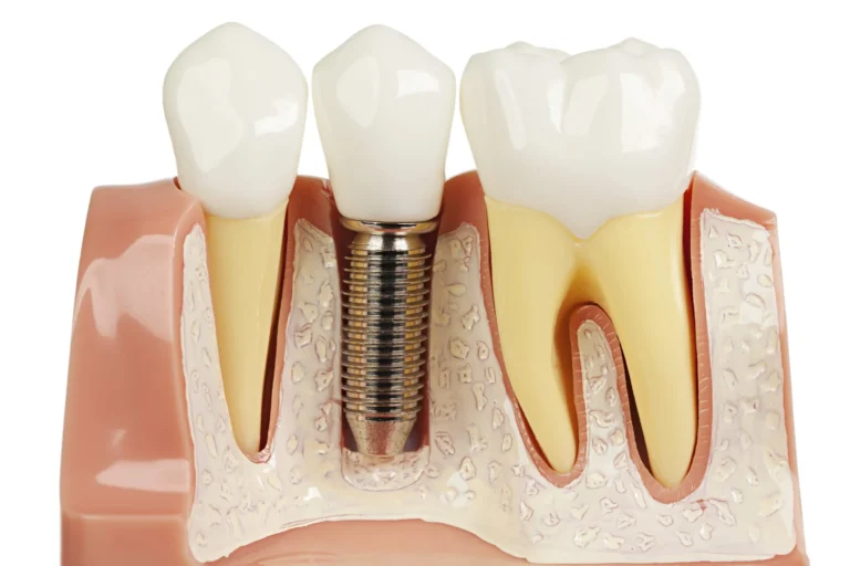 implant-dentar-scaled
