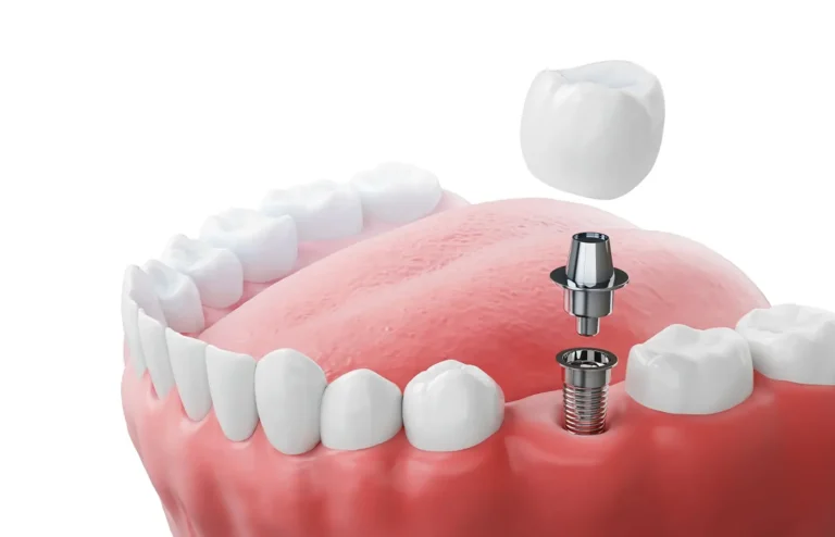 quali-sono-i-costi-per-un-impianto-dentale-500