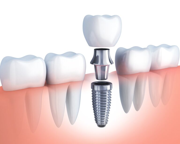 Impianti-dentali