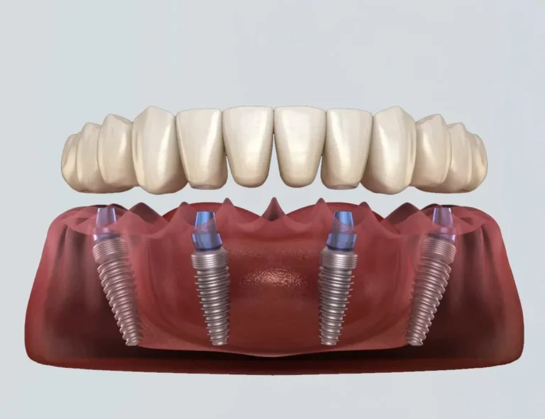 all-on-4-dental-implants-lower-jaw-illustration-1_1746464010