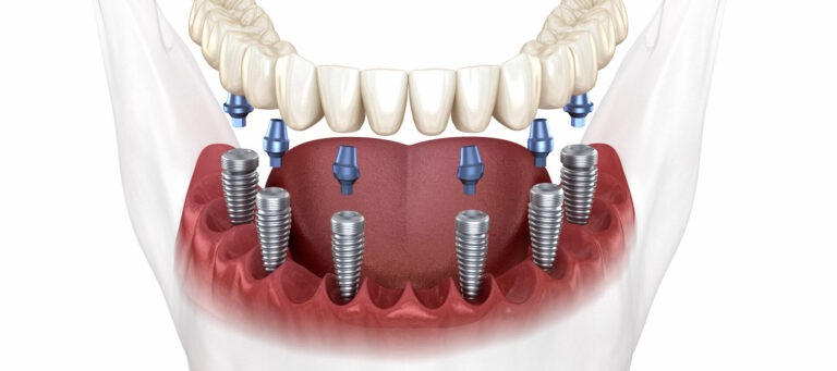 all-on-6-implant--1919x853