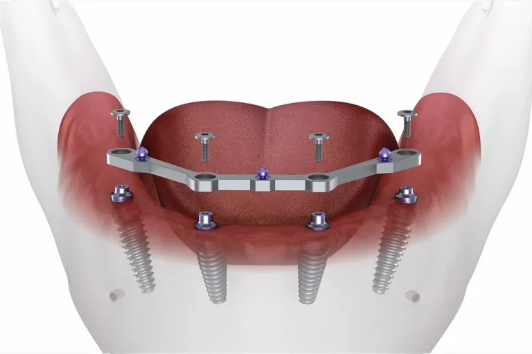 all_on_four_4_implant