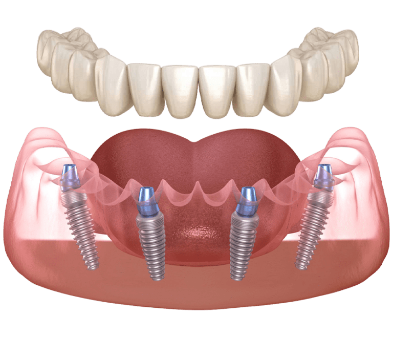 img-all-on-4-dental-implants