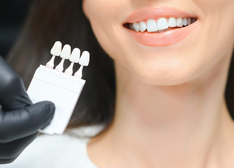 Applicazione di faccette dentali in ceramica per correggere macchie, scheggiature e difetti del sorriso